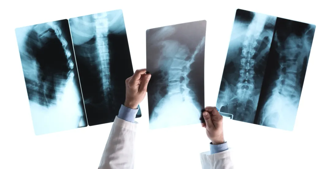 Pre-existing conditions personal injury claim California attorney Anthony Girgis Girgis Law Firm Encino